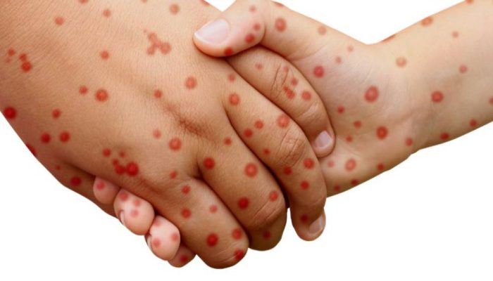 Sumenep Berstatus KLB Campak, 17 Orang Meninggal Dunia
